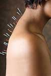 Acupuncture needles on the Spine